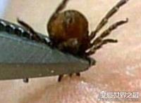 蜱虫叮咬后伤口图片，它的头会钻进人体内(皮肤会红肿一片)