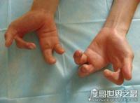 天生畸形的螃蟹手，8岁男童被丢弃三次终被治愈