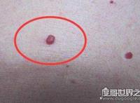 什么叫蜘蛛痣，痣的周围有呈放射性小血管分支(蜘蛛痣图片)