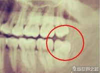 不需要拔的智齿图片，这4种情况下的智齿其实并不需要拔