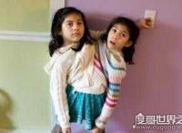 世界上最漂亮的连体人，曾出演电影《大鱼》（坚强独立）