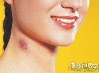 吻痕怎么快速消除，教你5招快速消除吻痕的方法