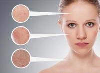 脂溢性湿疹的原因,症状和治疗