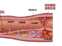 动脉硬化吃什么好你知道吗？