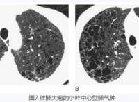 肺气肿吃什么好你知道吗？