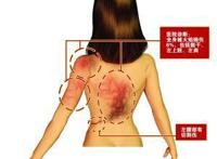 后背穴位减肥法