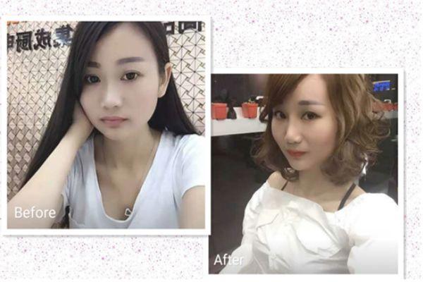 鼻翼缩小手术前后对比照片 缩鼻孔手术对比照片