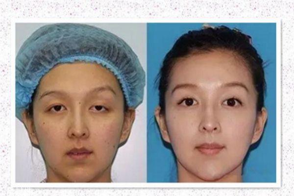 眼睑下垂能治疗吗 眼睑下垂治疗方法