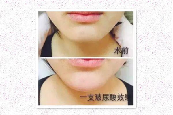 玻尿酸打下巴怎么打的 玻尿酸打下巴是什么感觉