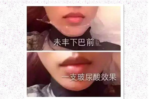 玻尿酸打下巴怎么打的 玻尿酸打下巴是什么感觉