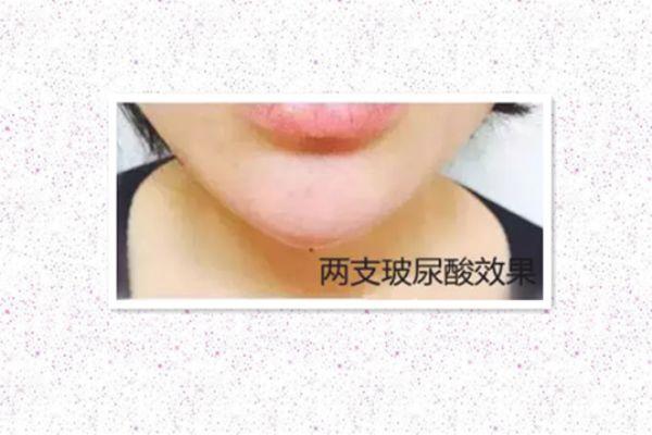 玻尿酸打下巴怎么打的 玻尿酸打下巴是什么感觉
