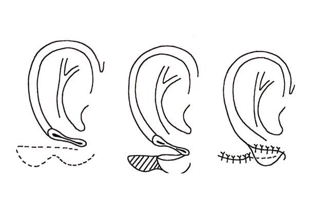 丰耳垂的危害 丰耳垂是什么意思