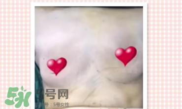 假体隆胸取出后图片 隆胸假体取一月图片