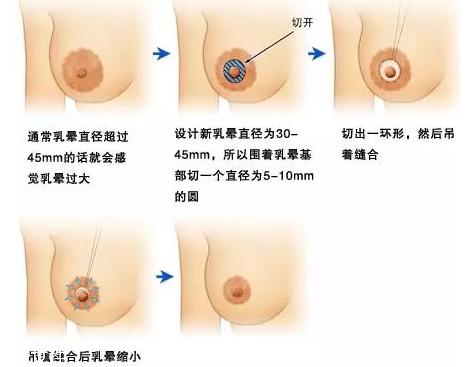 乳晕缩小术怎么做？乳晕缩小术知识全解