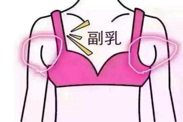 如何去副乳的方法 减掉副乳的最快方法