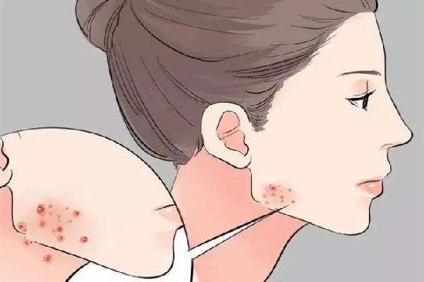 武汉看痘痘去什么医院最好 武汉看痘痘可以用医保吗