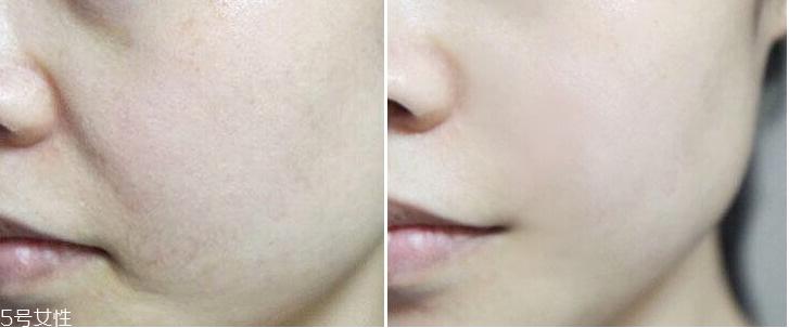 微针眼膜能天天使用吗 一个礼拜用一次