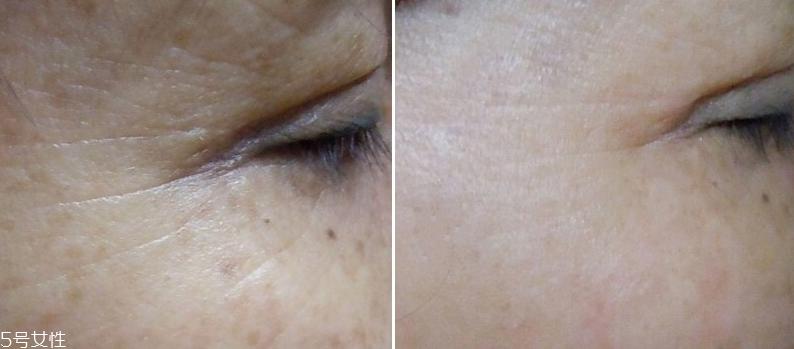 微针眼膜能天天使用吗 一个礼拜用一次