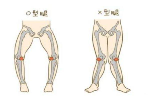 腿型不好看怎么办 如何修正O型腿