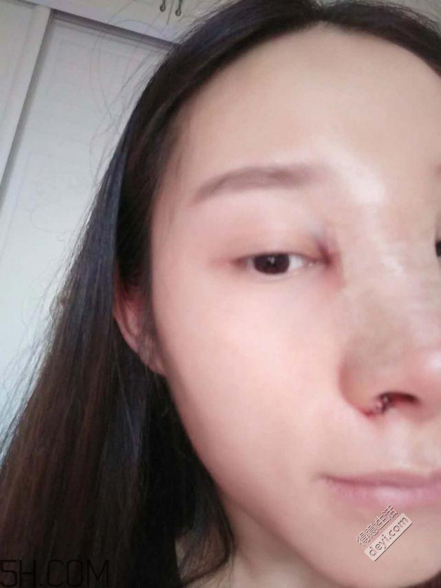 鼻头缩小术过程图 鼻头缩小手术千万别做后悔死