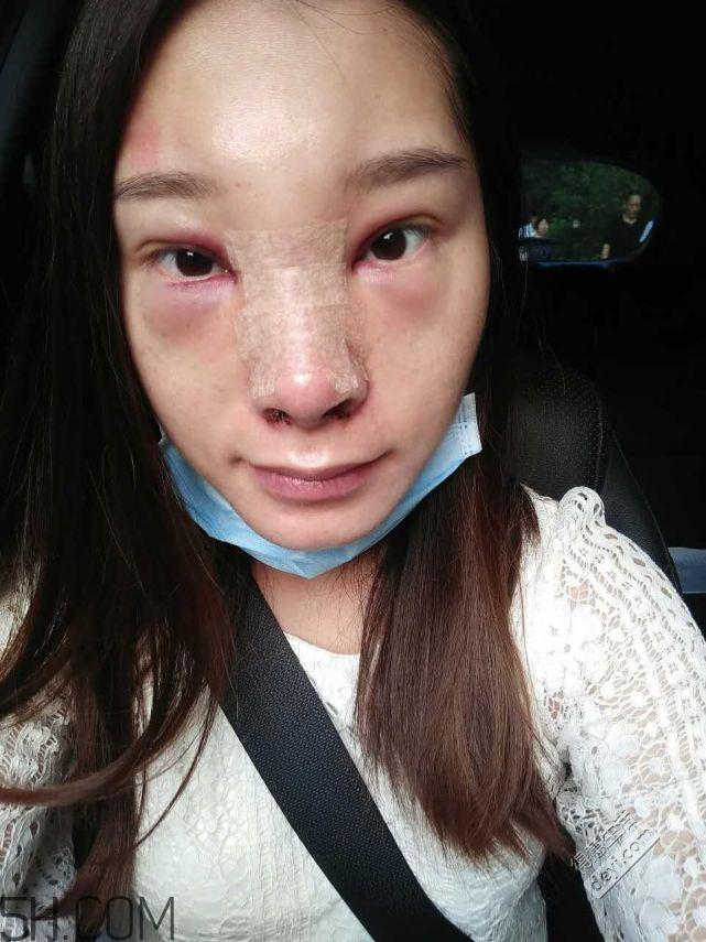 鼻头缩小术过程图 鼻头缩小手术千万别做后悔死