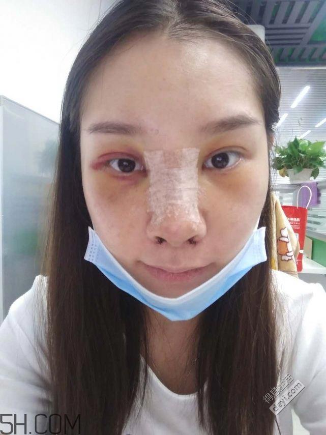 鼻头缩小术过程图 鼻头缩小手术千万别做后悔死
