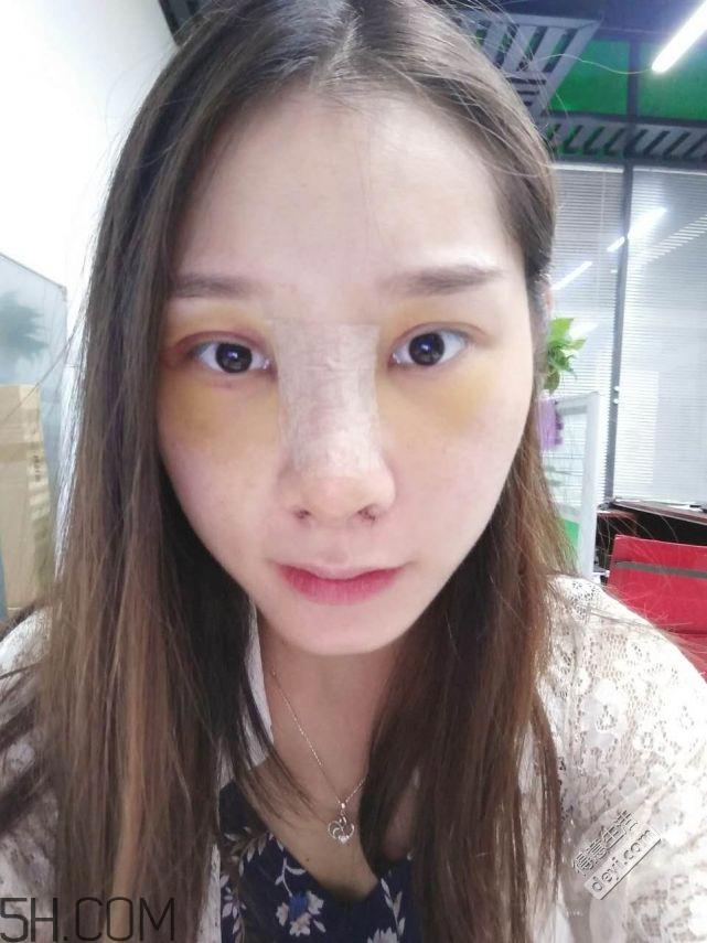 鼻头缩小术过程图 鼻头缩小手术千万别做后悔死