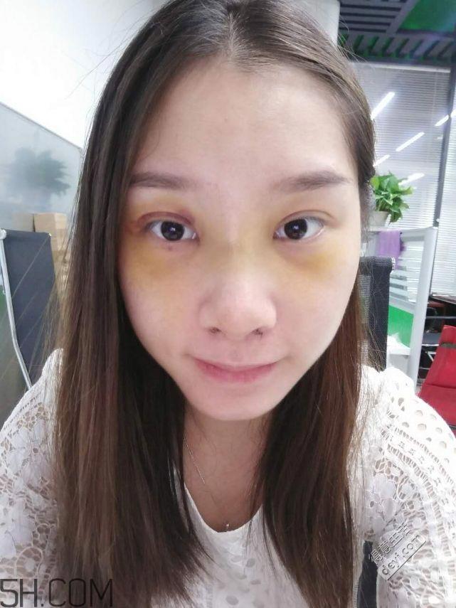 鼻头缩小术过程图 鼻头缩小手术千万别做后悔死