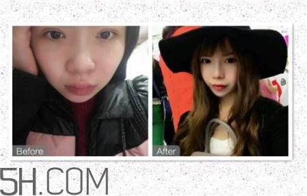 鼻头缩小术过程图 鼻头缩小手术千万别做后悔死