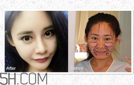 鼻头缩小术过程图 鼻头缩小手术千万别做后悔死