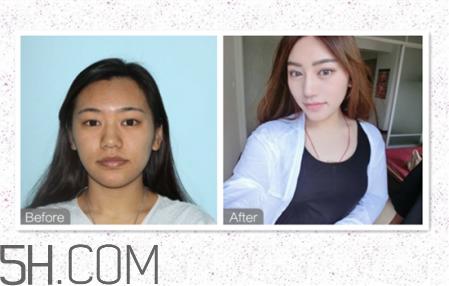 鼻头缩小术过程图 鼻头缩小手术千万别做后悔死