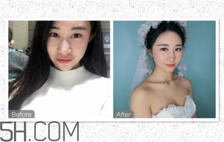 鼻头缩小术过程图 鼻头缩小手术千万别做后悔死