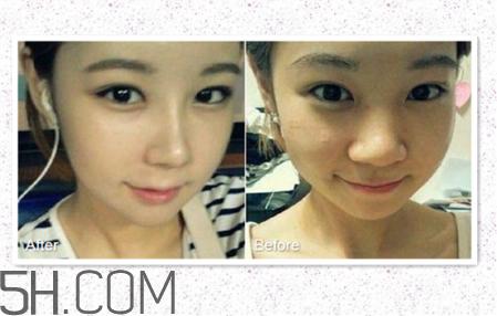 鼻头缩小术过程图 鼻头缩小手术千万别做后悔死