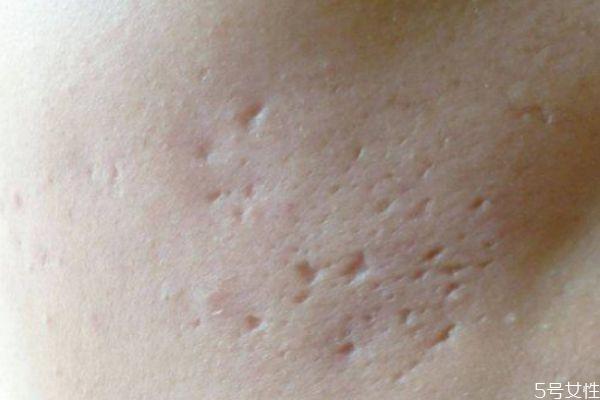 脸上有痘坑怎么办 脸上痘坑怎么消除