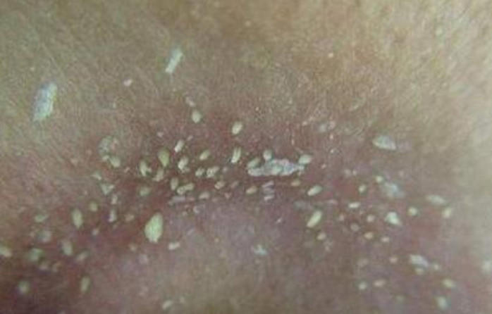 从鼻子上挤出来的白色东西是什么东西 4个去除方法