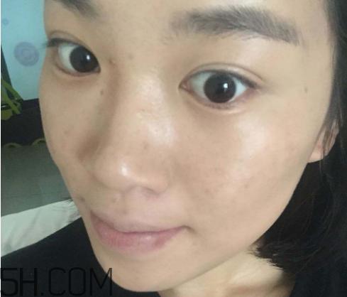 上宫庄祛痘骗局 上宫庄祛痘怎么样