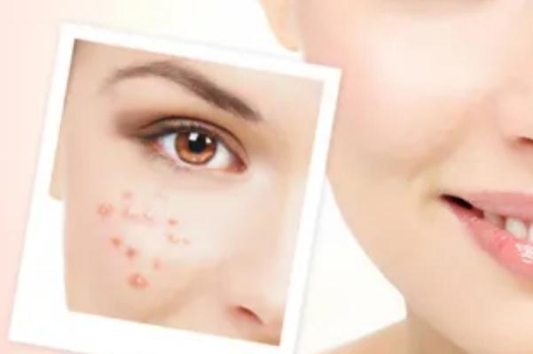 激光祛痘有副作用么 激光祛痘有后遗症吗