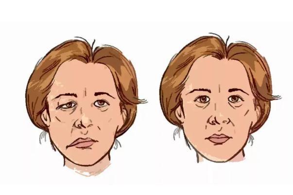 面瘫是什么病 女子回家路上被冷风吹成面瘫