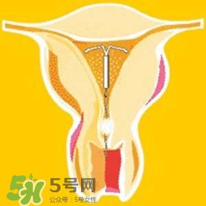 避孕环安全吗?避孕环是什么样子的图片