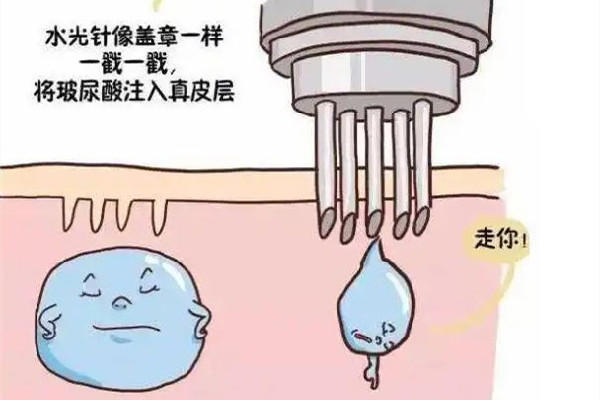 水光针打深好还是浅好 水光针去皱纹维持多久