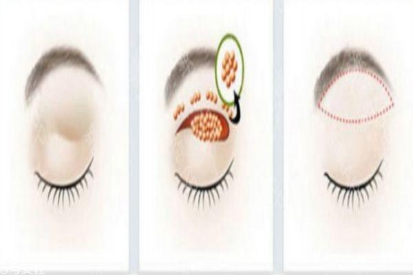 如何去肿眼泡 为什么人会有肿眼泡