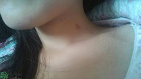 种草莓吻痕是什么意思？吻痕是怎么弄出来的？