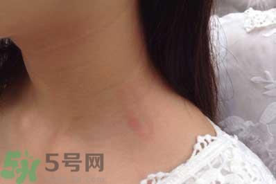 种草莓吻痕是什么意思?吻痕是怎么弄出来的?