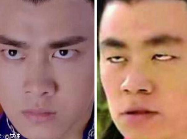 死鱼眼怎么治?割双眼皮可以治死鱼眼