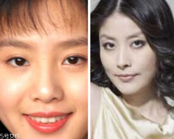 死鱼眼怎么治？割双眼皮可以治死鱼眼