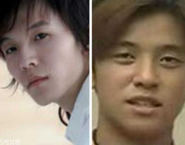 死鱼眼怎么治？割双眼皮可以治死鱼眼