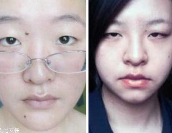 死鱼眼怎么治？割双眼皮可以治死鱼眼