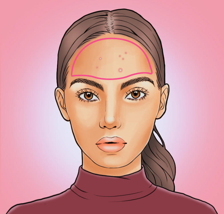 脸上长痘痘位置原因图解 各部位长痘调理各不同