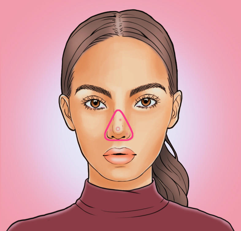 脸上长痘痘位置原因图解 各部位长痘调理各不同