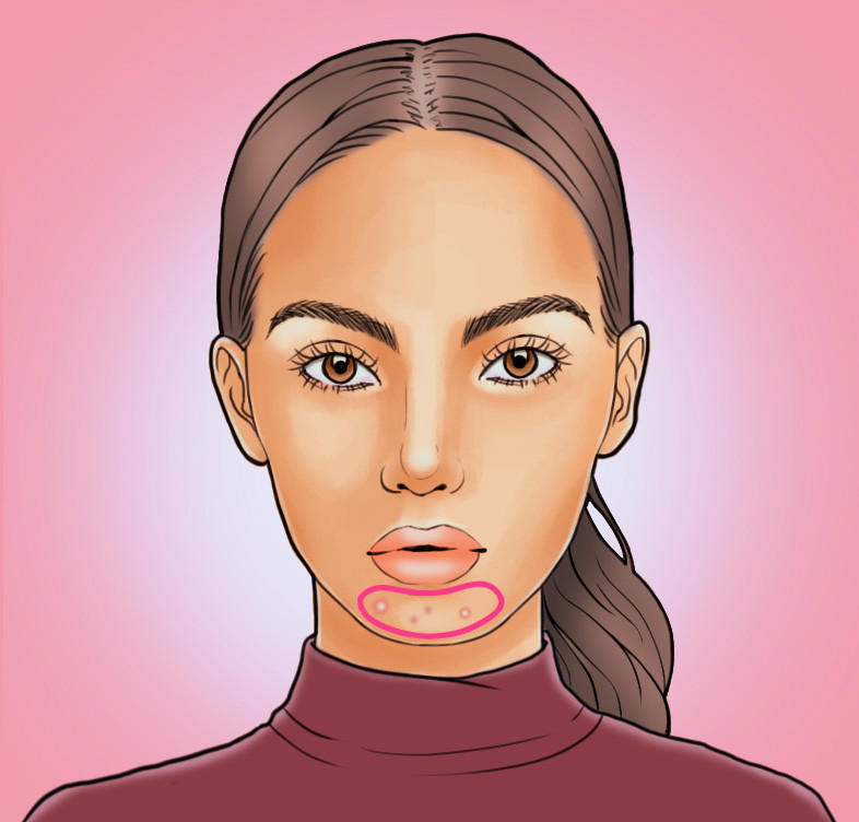 脸上长痘痘位置原因图解 各部位长痘调理各不同